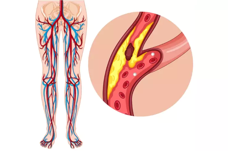 peripheral-vascular-interventions-1